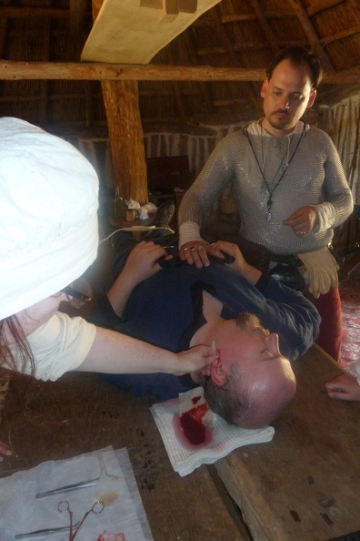 Entfernung des Kualinwurms.JPG